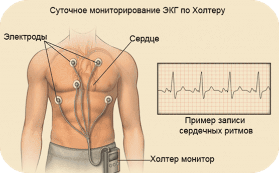 Суточное мониторирование ЭКГ по Холтеру