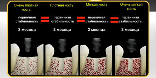 Зубной имплантат Эниридж