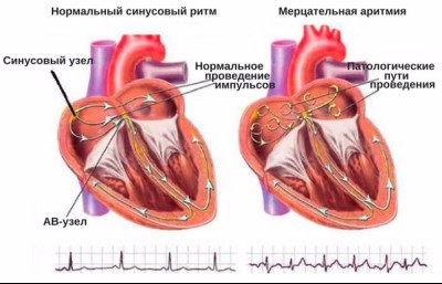 Методы лечения аритмии сердца. Кардиолог в Кирове