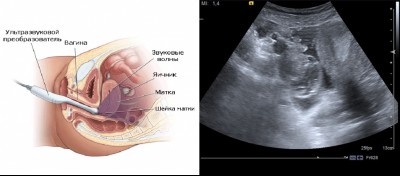 Показания к узи органов малого таза в Кирове