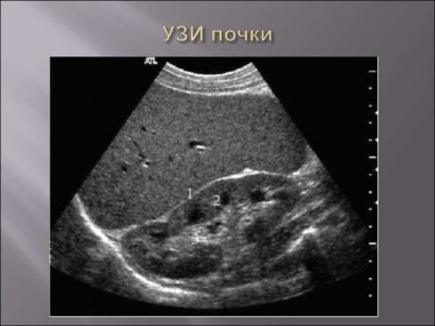 УЗИ почек и мочевого пузыря выявляет аномалии структуры тканей, наличие объемных образований