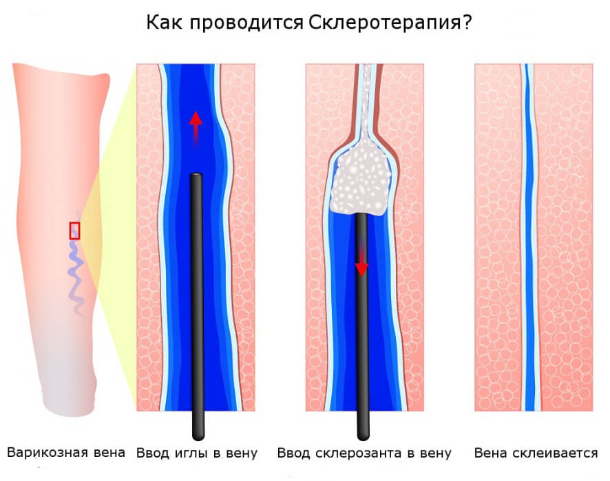 Процедура склеротерапии