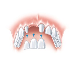 Установка зубного моста